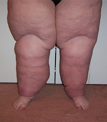 Lymphatic Drainage Clinic in Montreal