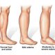 lymphedema clinic in montreal