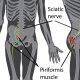 Sciatic Nerve Treatment in Montreal