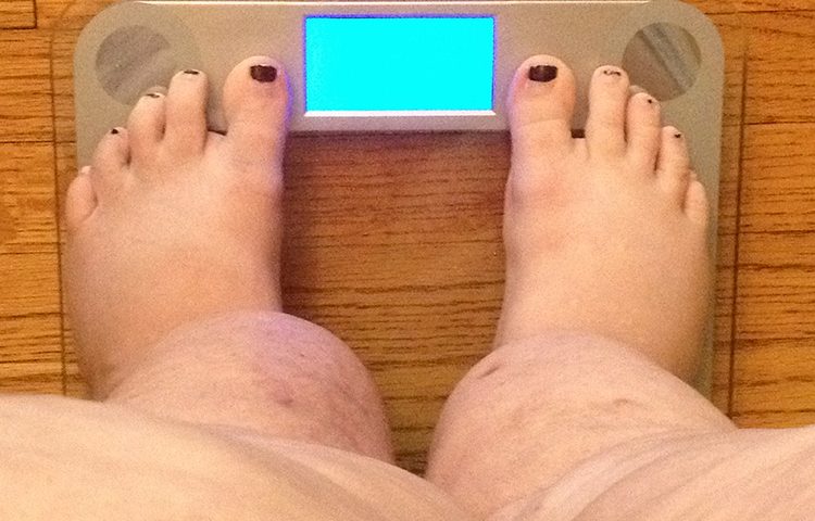 Obesity and Lymphedema - Can Lymphatic Massage help?